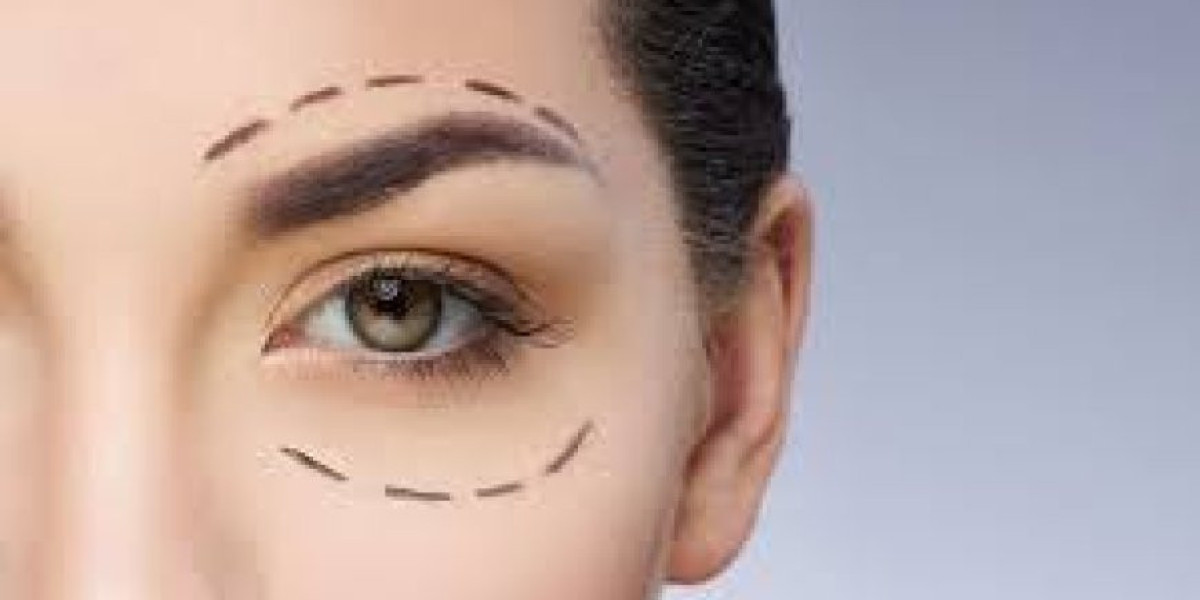 Upper Blepharoplasty Dubai Revitalize Your Eyes for a Fresh Look