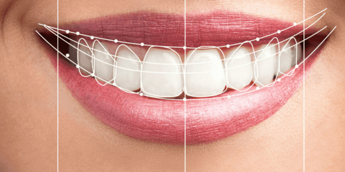 Get the Perfect Hollywood Smile in Dubai Today