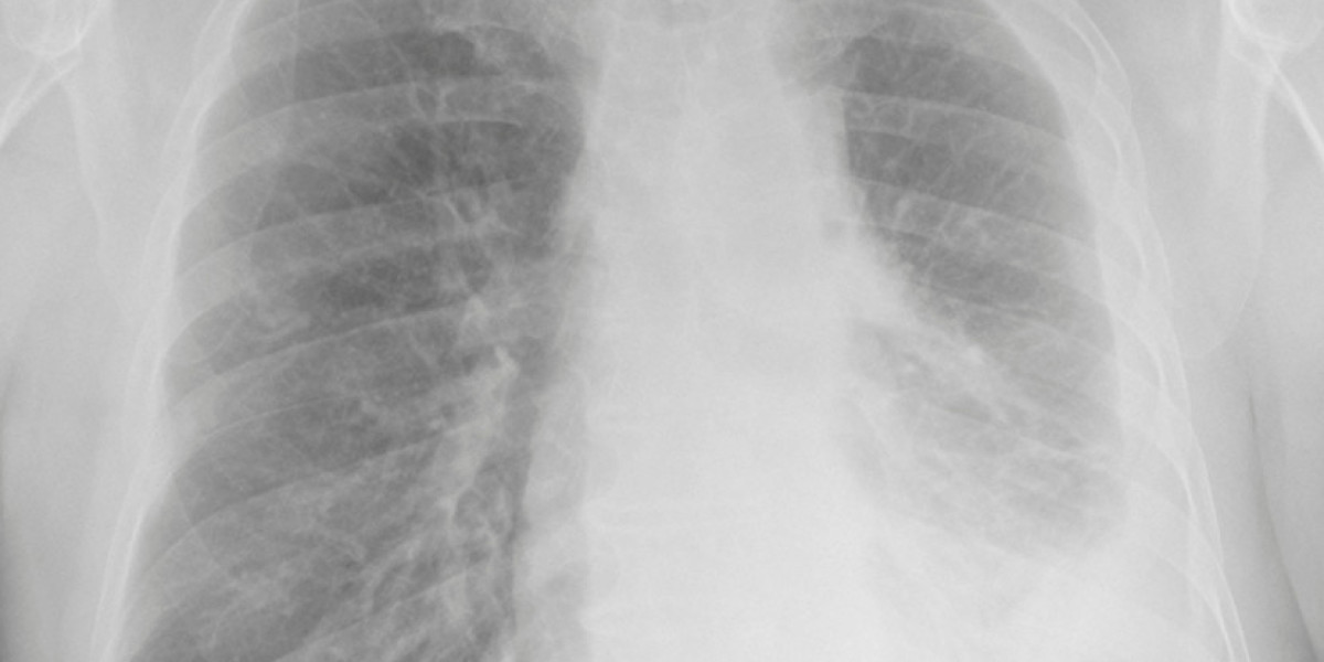 Malignant Mesothelioma Therapeutics Market Report 2034