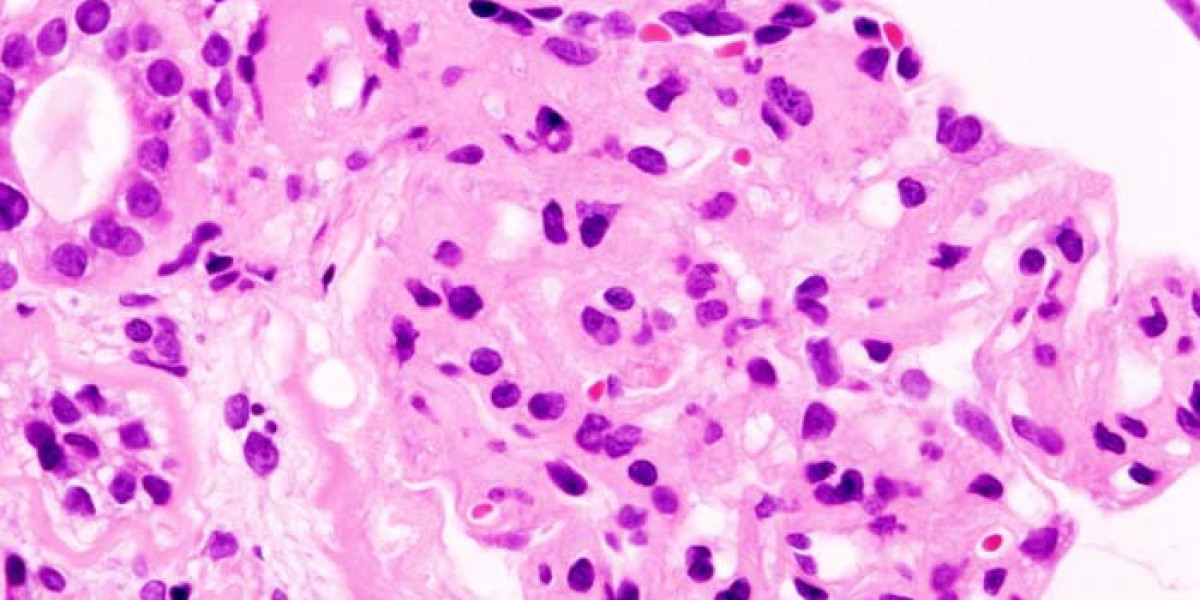 Pathways to Remission in Minimal Change Disease and Membranous Nephropathy