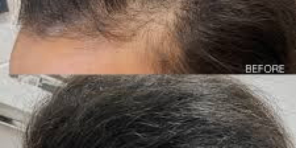 Hair Restoration Market driven by evolving lifestyle patterns influencing aesthetic healthcare expenditure