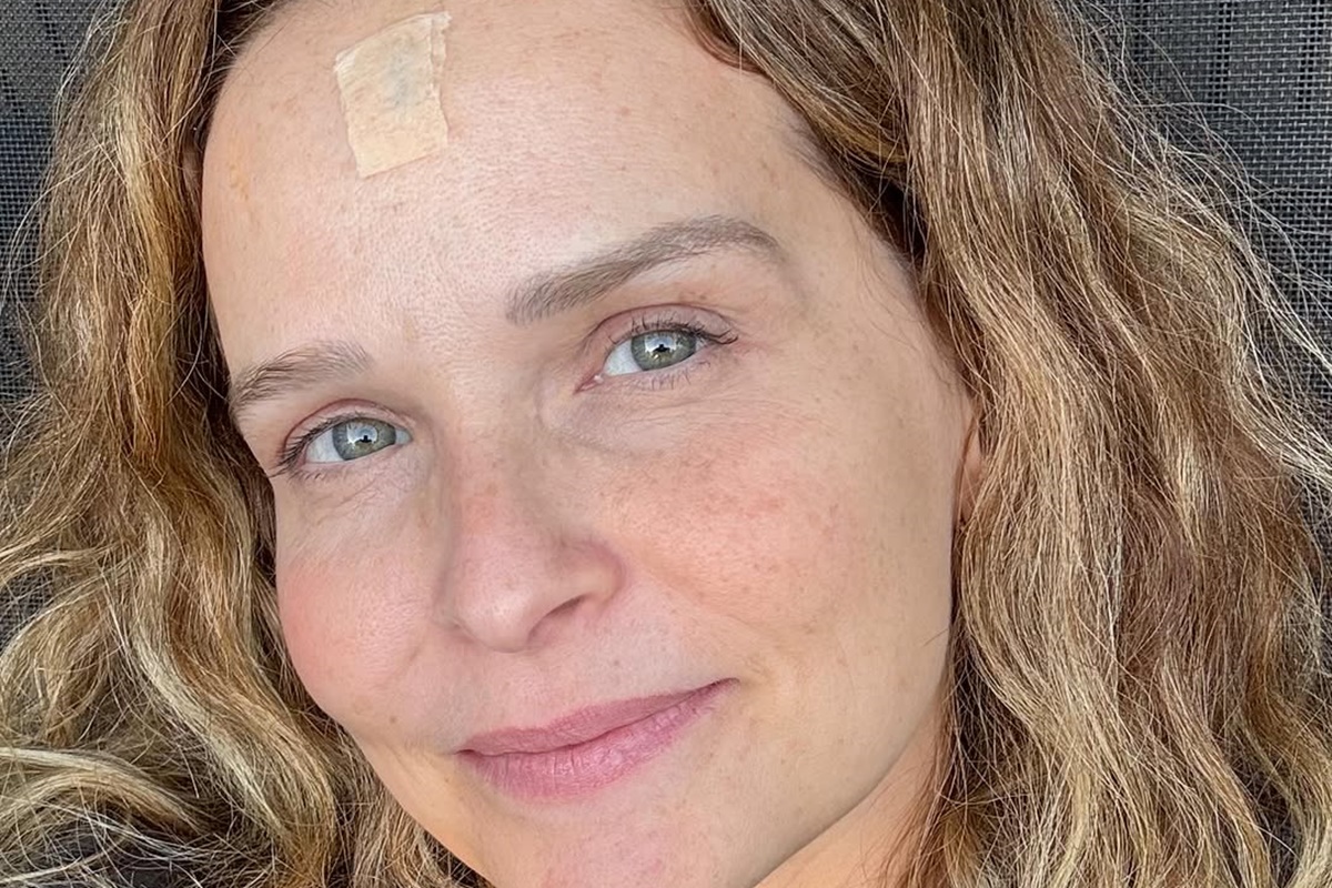 Cirurgião Plástico alerta sobre carcinoma de Fernanda Rodrigues: "É um dos tipos de câncer mais comuns no Brasil